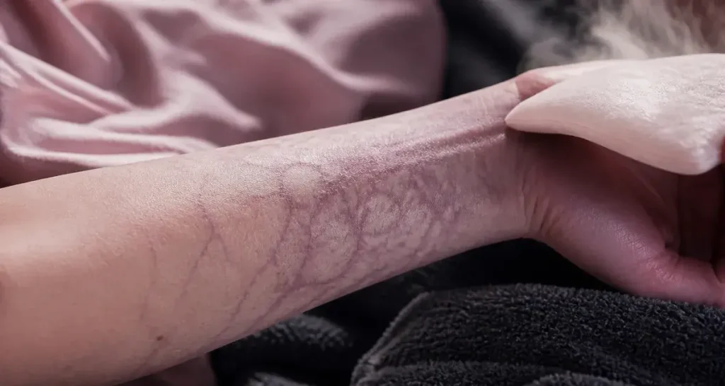 Peau marbrée : livedo reticulaire violet sur avant-bras