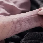 Peau marbrée : livedo reticulaire violet sur avant-bras